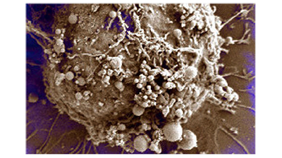Extracellular Vesicles in Brain Cancer Blood Testing Extracellular Vesicles in Brain Cancer Blood Testing - November 2018 Advances article